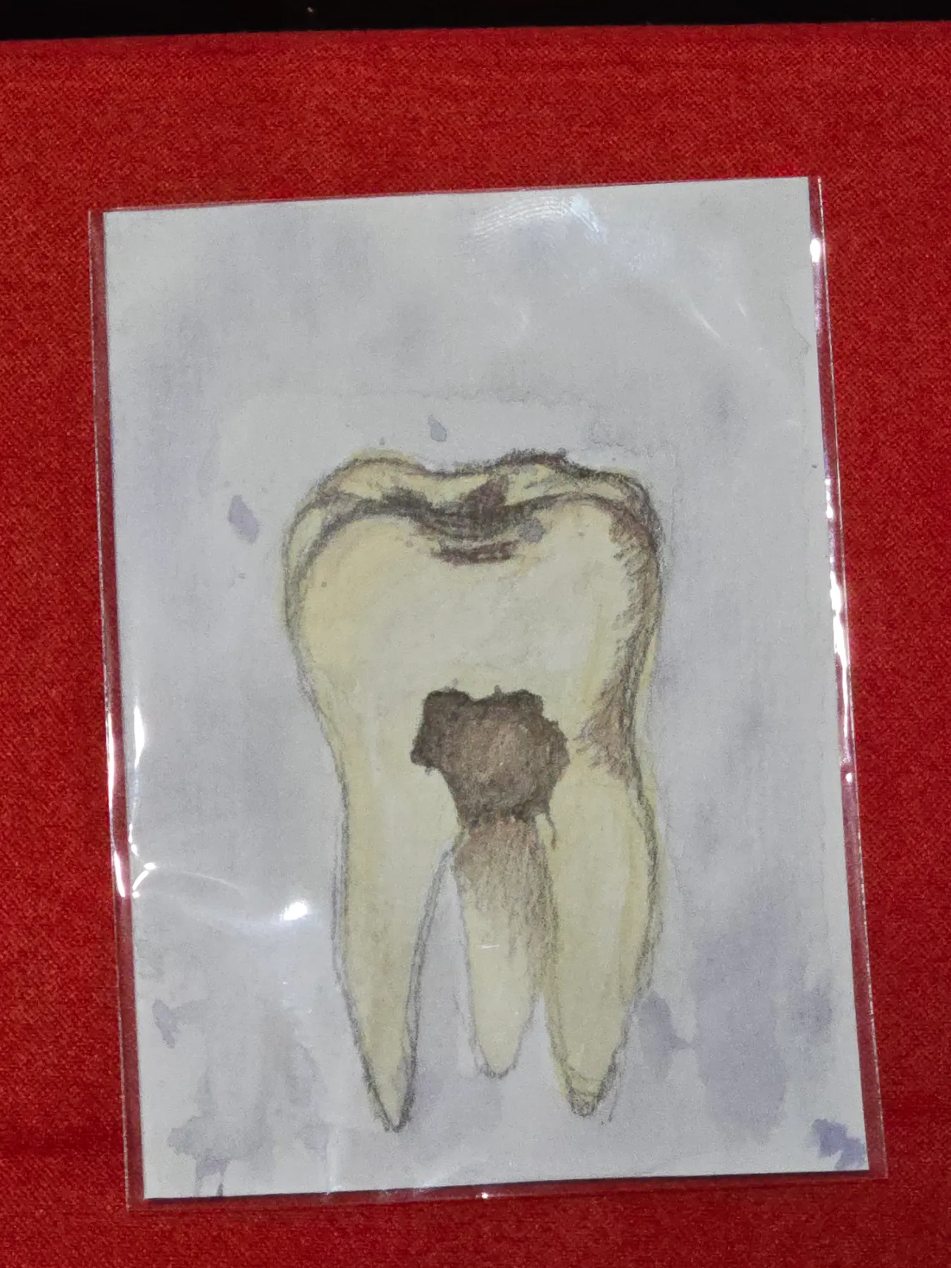 Tooth Decay aceo art card